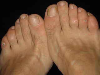 Corns on toes