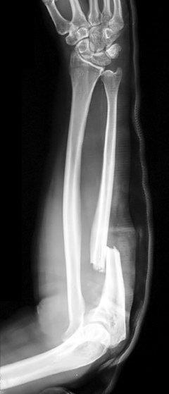 Monteggia fracture