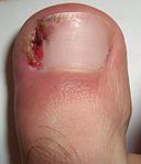Ingrowing toenail