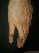 Boutonniere deformity