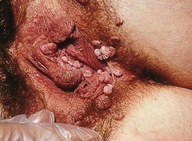 Anogenital warts female