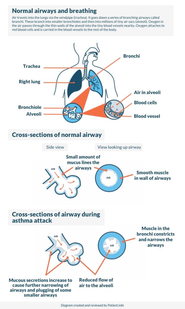 Asthma
