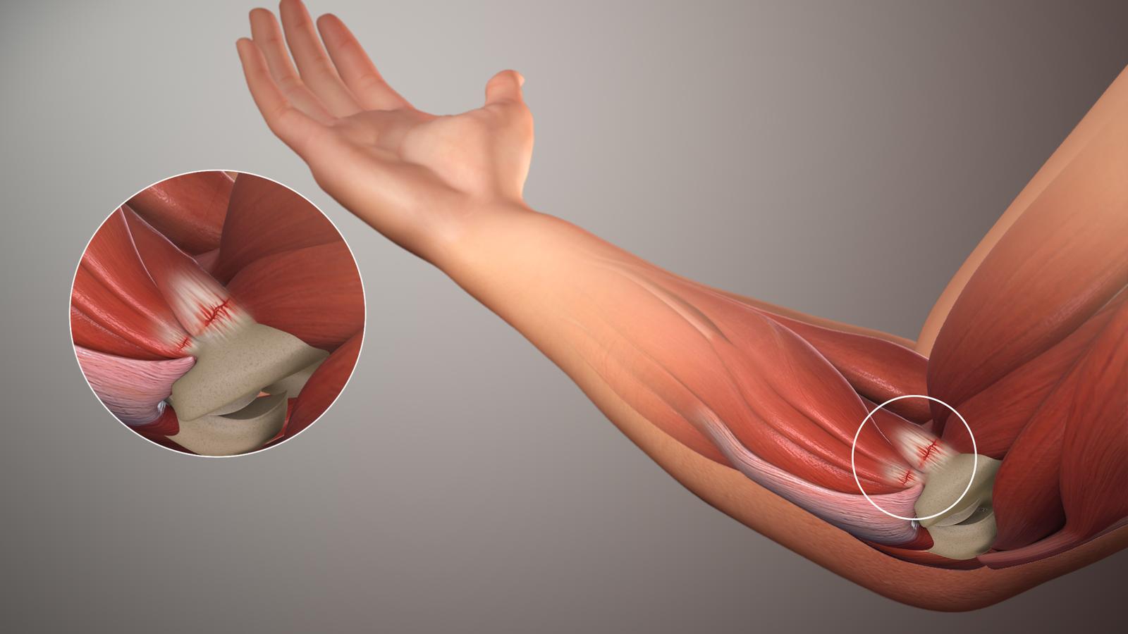 Golfer's elbow