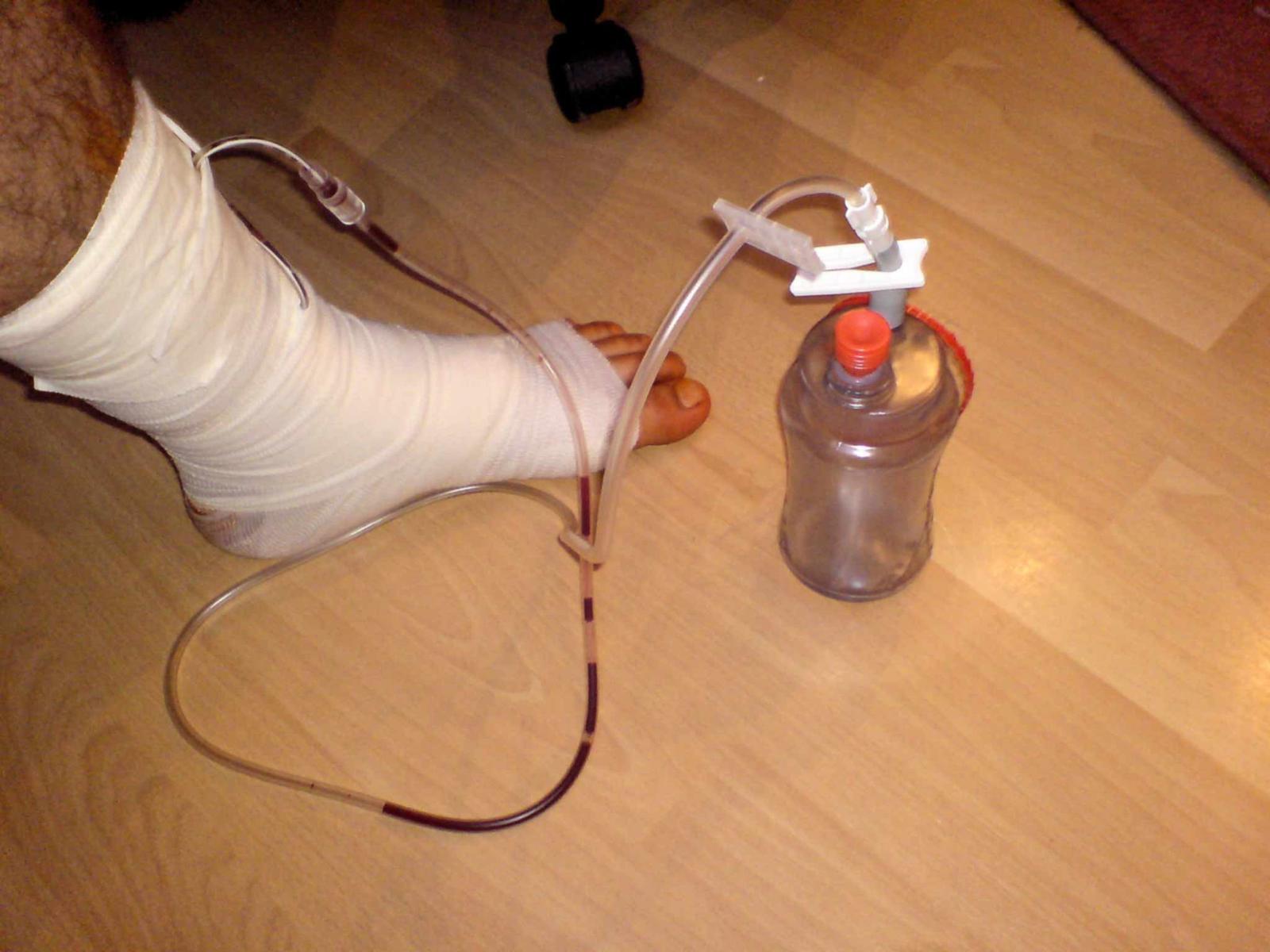 open access image of leg surgical drain