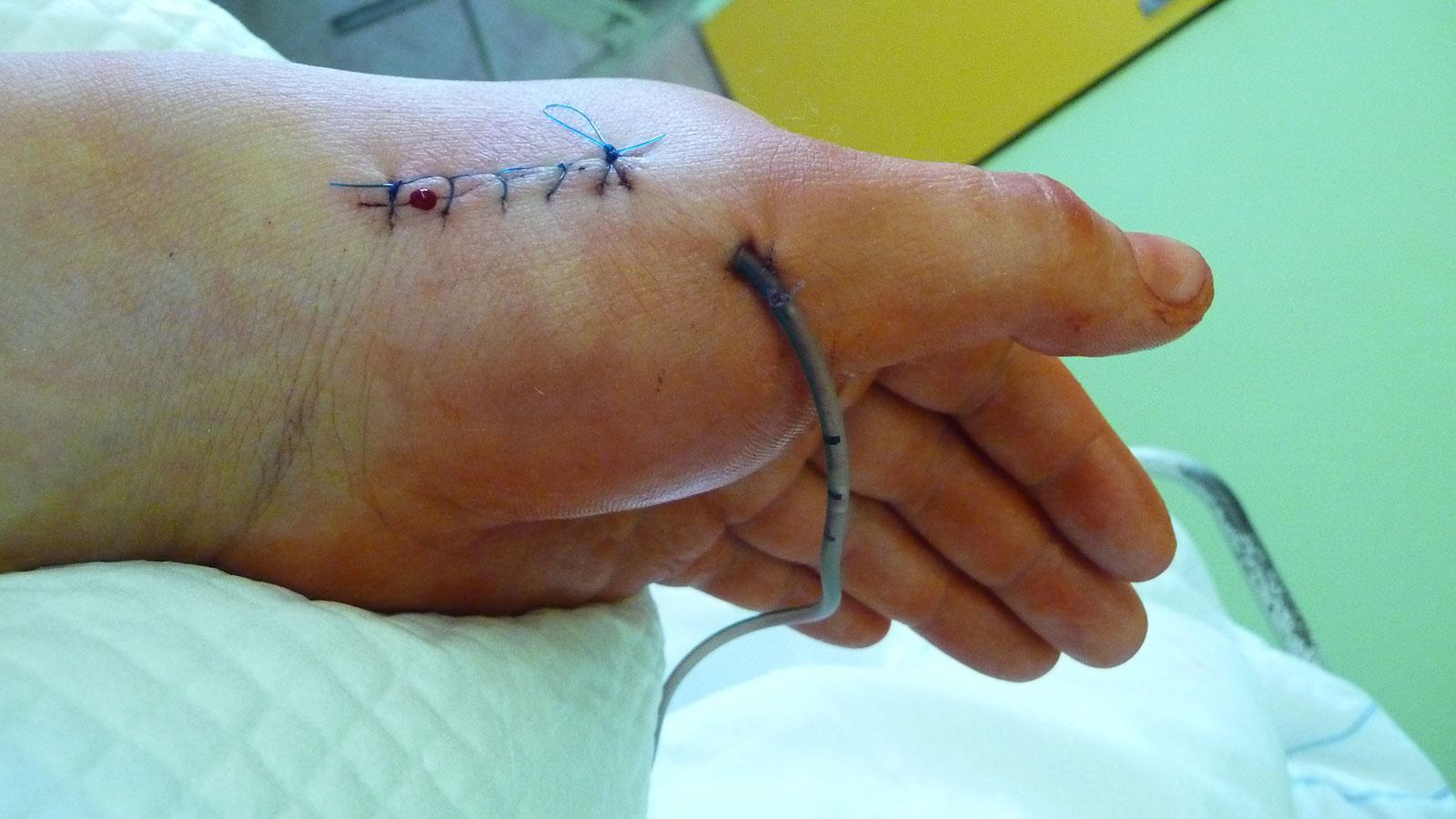 open access hand surgical drain