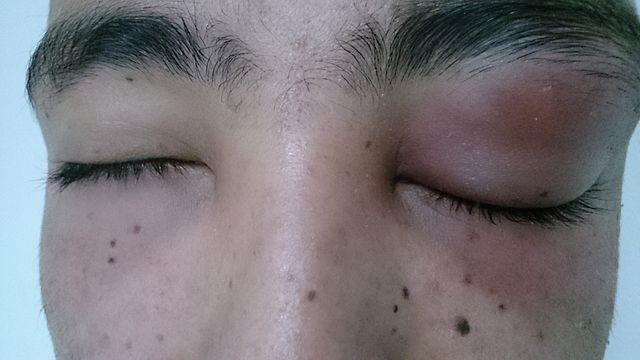 Periorbital cellulitis