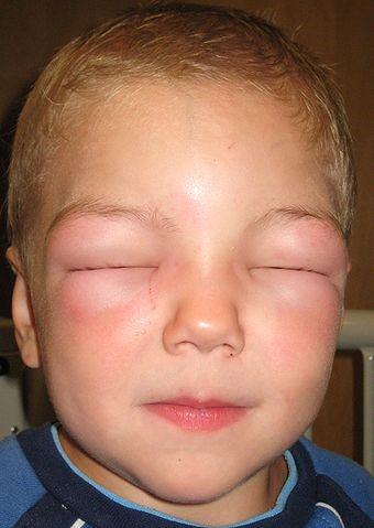 Angio-oedema