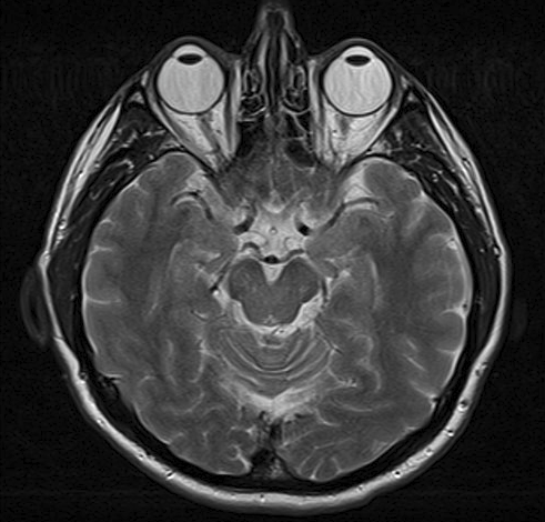 MRI scan