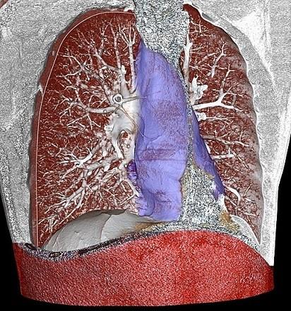 Mediastinum