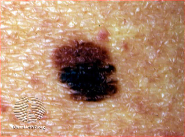 Atypical naevus