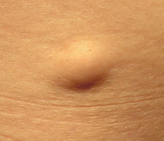 Superficial subcutaneous lipoma