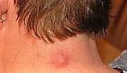 Epidermoid cyst on the neck