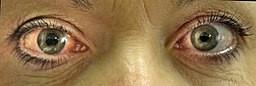 Acute angle-closure glaucoma