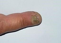 Tinea unguium