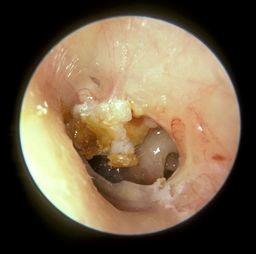 Cholesteatoma