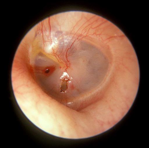 Tympanic membrane perforation