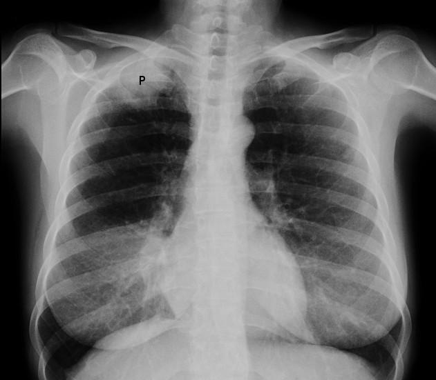 Pancoast tumour