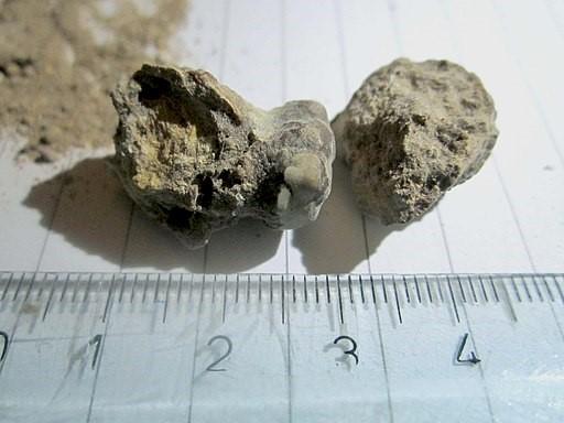 Renal calculi