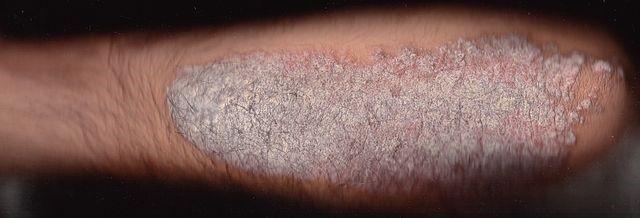 Plaque psoriais
