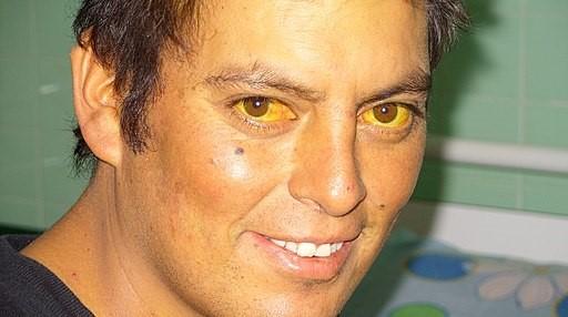 Scleral icterus