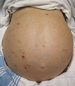 Hepatic failure