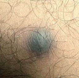 Dermatofibroma