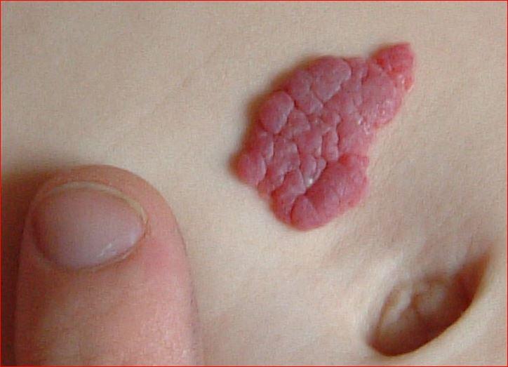 Haemangioma - strawberry naevus