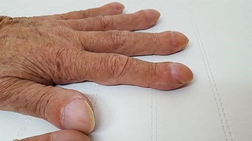 Finger clubbing