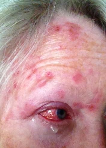 Herpes zoster