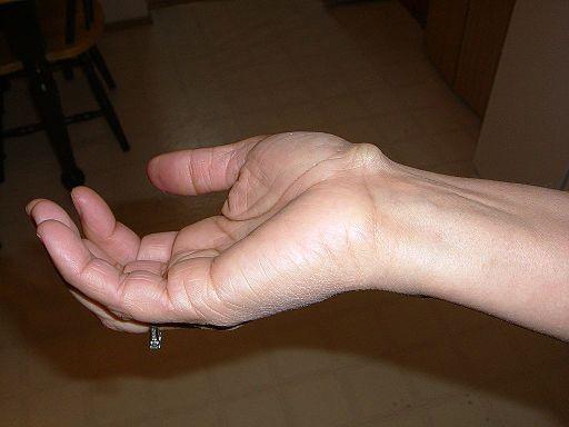ganglion cyst wrist