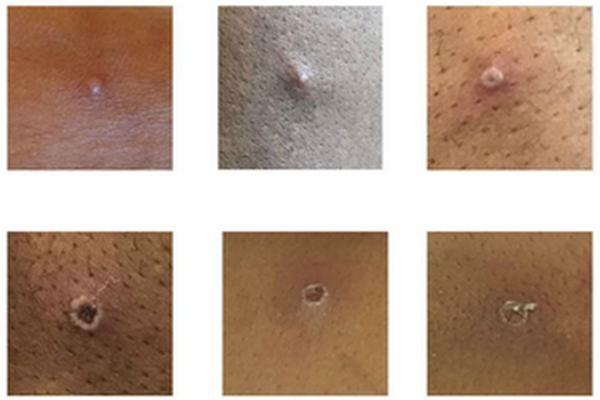 Monkeypox appearance
