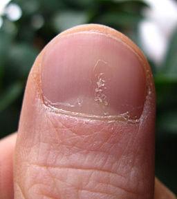 Nail psoriasis