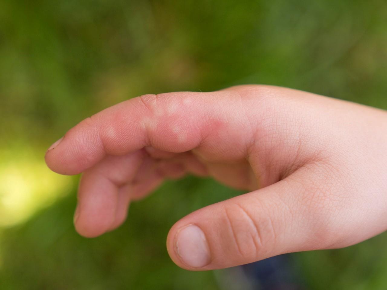 Nettle sting