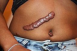 Keloid post-surgery