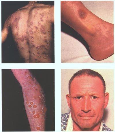 Drug eruptions