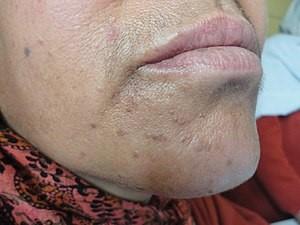 Flat warts