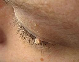 Filiform wart