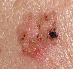 Bowen's Disease