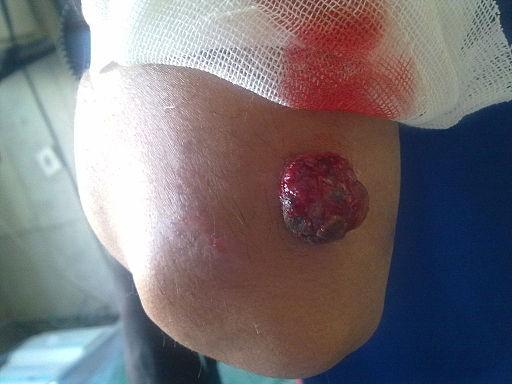 Pyogenic granuloma