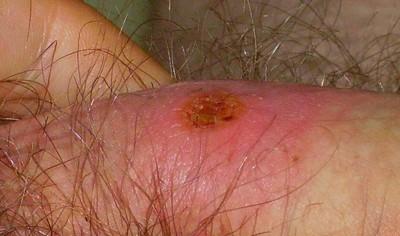 Syphilis