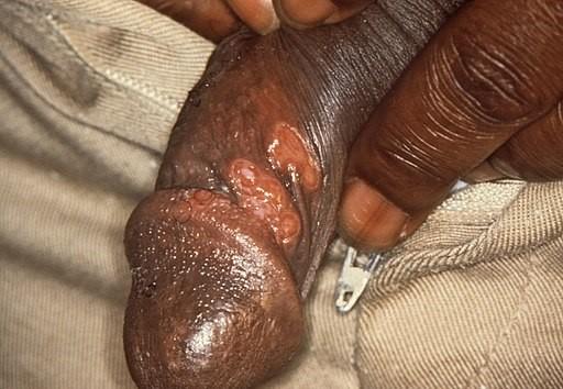 Syphilis