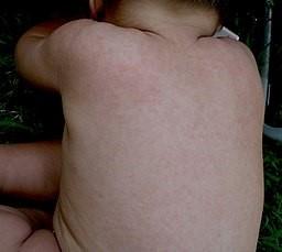 Roseola