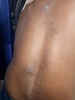 Discoid eczema