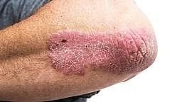 Plaque psoriasis
