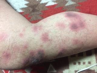 Chronic changes on the skin of the legs due to discoid (nummular) eczema (Wikimedia Commons)