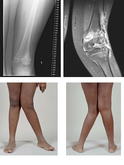 Valgus