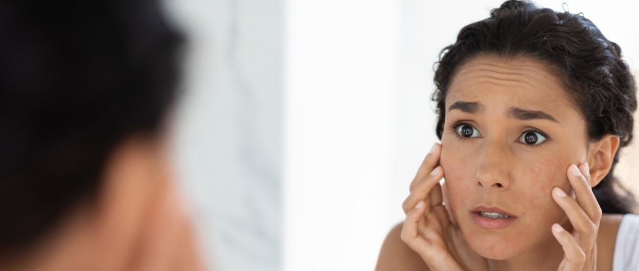 Facial eczema