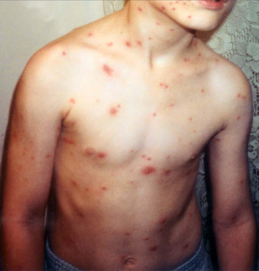 Photo of child with chickenpox