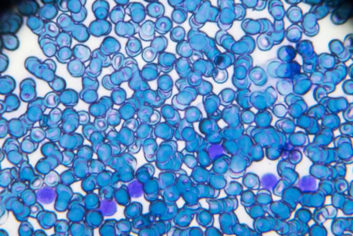 Leukaemia