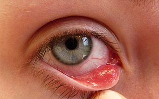 Stye (Sty): Eyelid Infection Symptoms, Causes, and Treatment